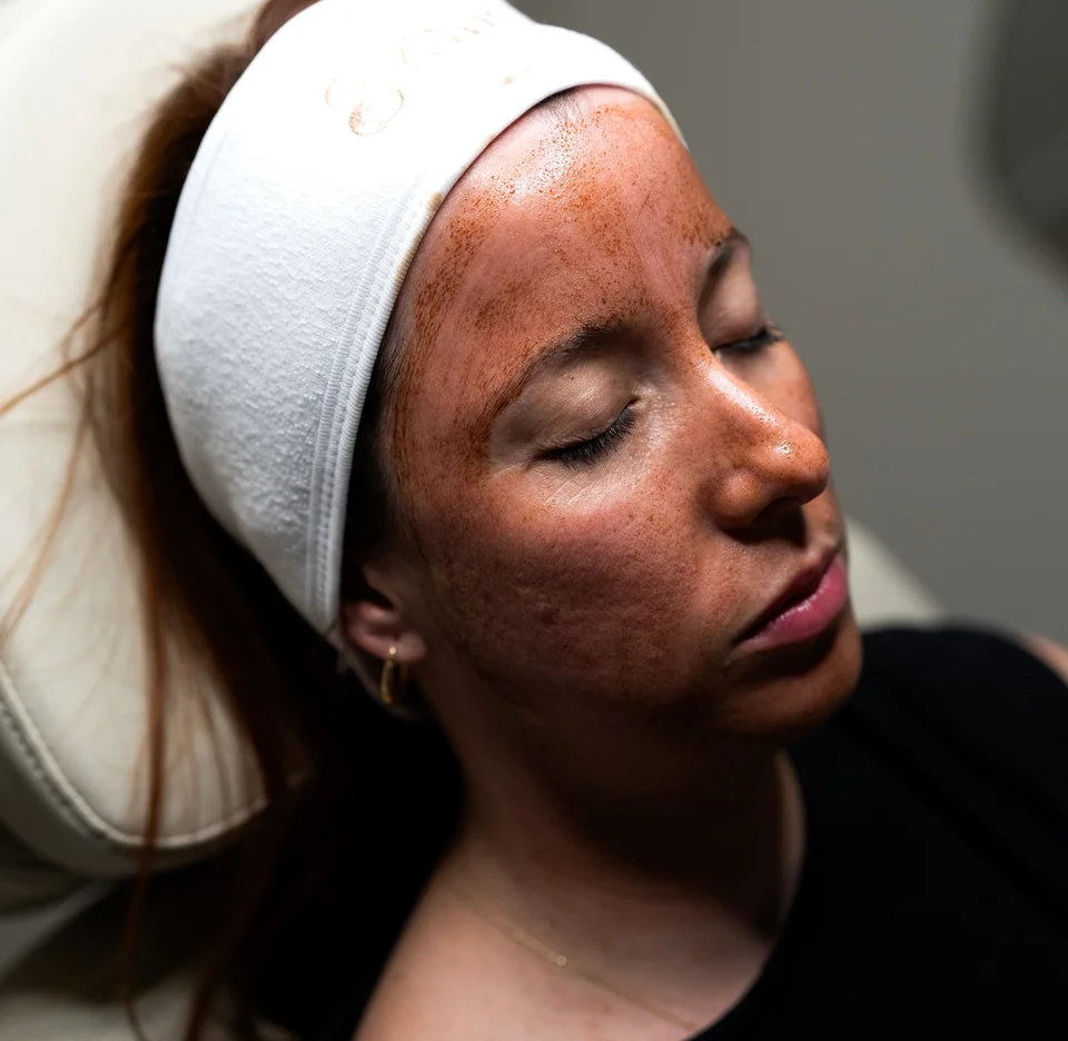 Peeling químico en Miami: guía completa para renovar tu piel en un medspa boutique
