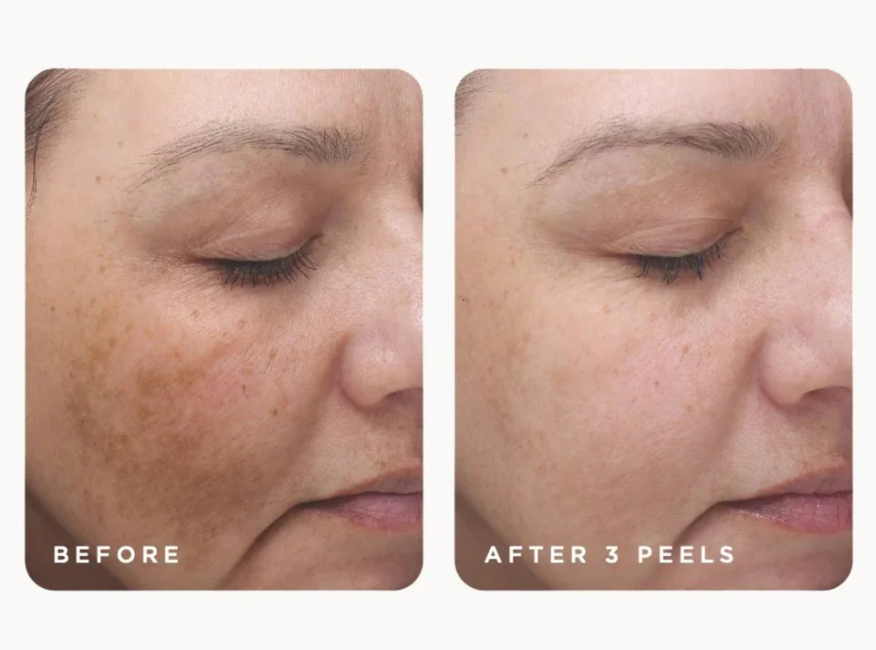 Tratamiento de hiperpigmentación en Miami: manchas oscuras, melasma y tono desigual — qué funciona de verdad