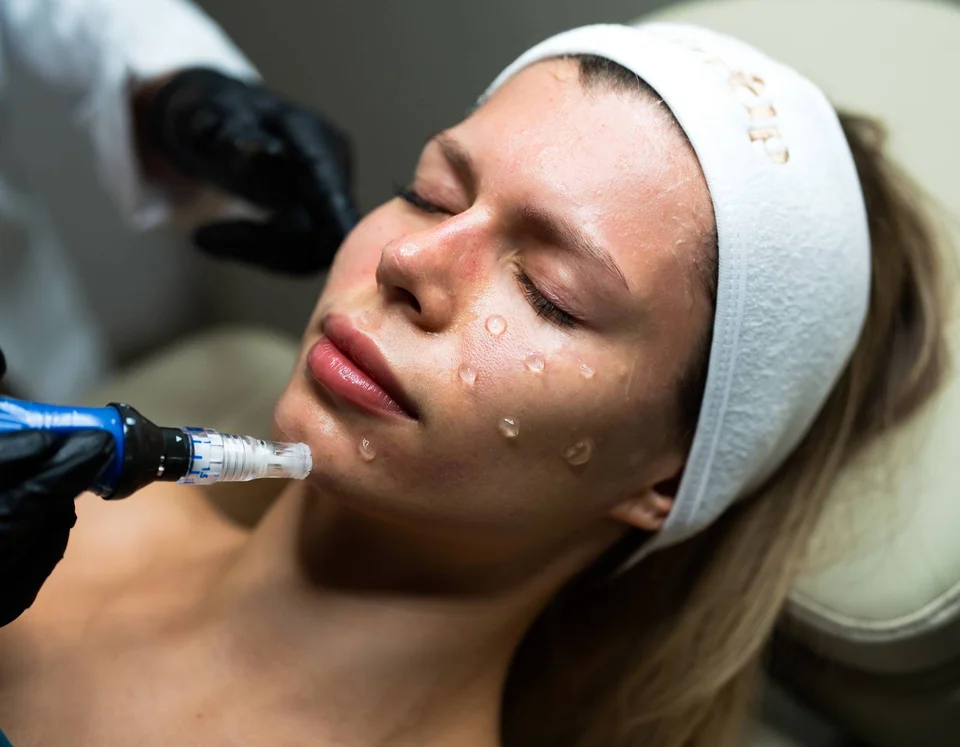 Morpheus8 vs. SkinPen Microneedling en Miami: Por Qué Elegimos SkinPen