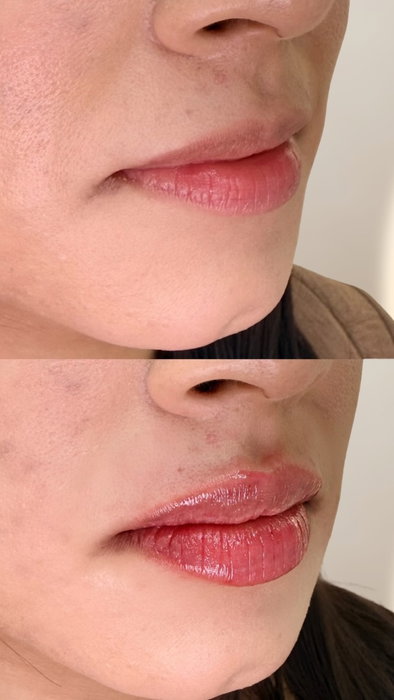 “Esto era exactamente lo que quería” 🥹💋

No se trata de cambiar tus labios, sino de realzarlos respetando tu forma, tus proporciones y lo 
