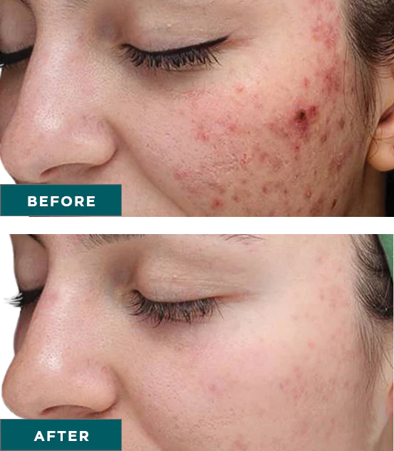 VI Chemical Peel - Before and after results